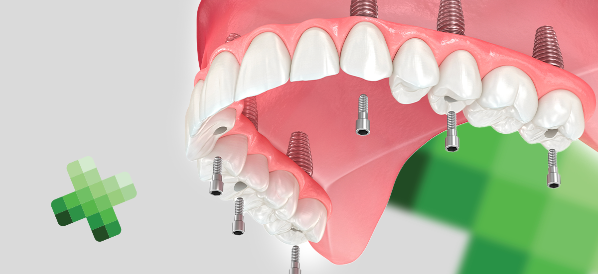 Tout Sur 4 Et Sur 6 Implant Dentaire